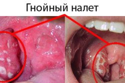 Гнойный налет при лакунарной ангине