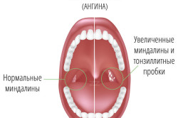 Тонзиллит как осложнение после ангины