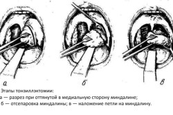 Этапы тонзиллэктомии