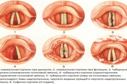 Схема проявления туберкулеза гортани