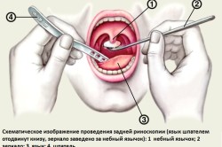 Принцип риноскопии при фарингите
