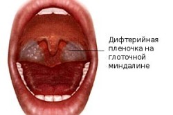 Дифтерийная ангина
