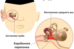 Отит - осложнение ангины